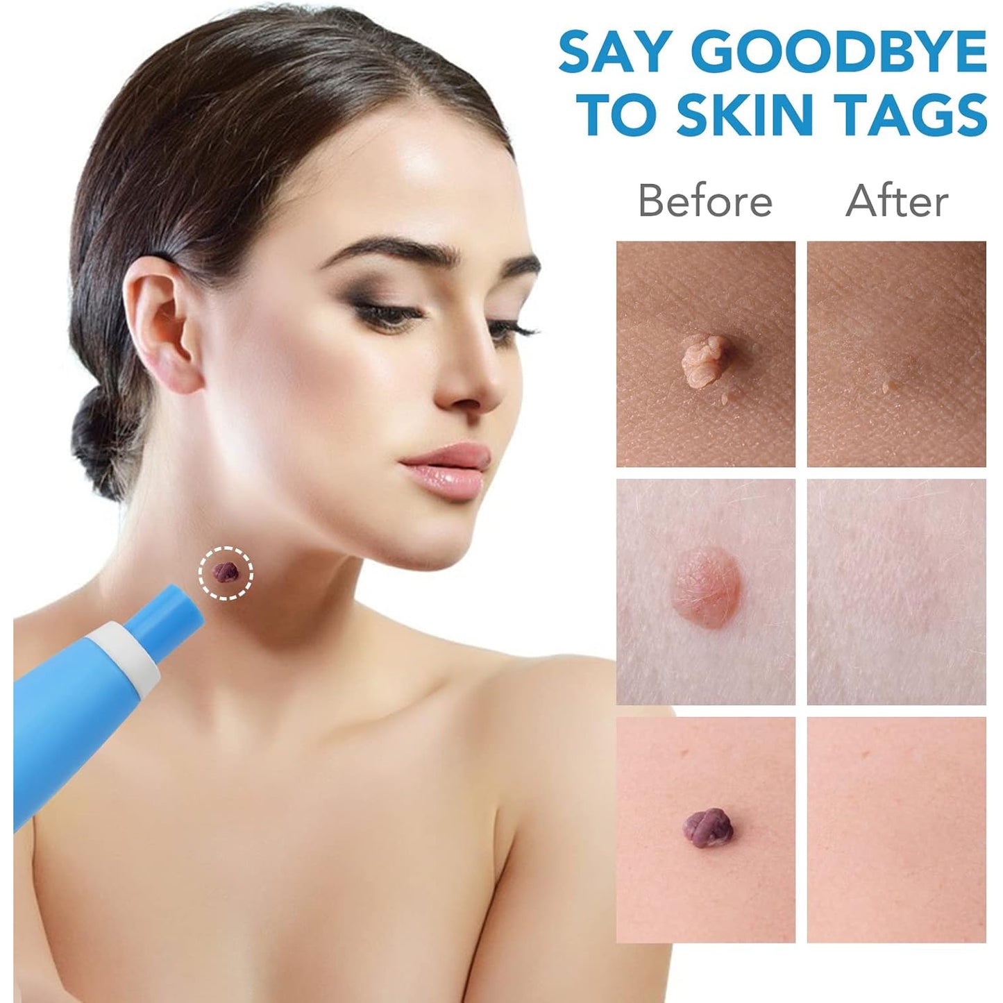 Skin Tag Remover Kit 2-in-1 (2 mm – 8 mm)