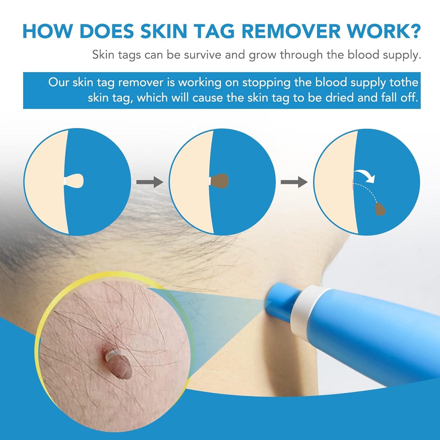 Skin Tag Remover Kit 2-in-1 (2 mm – 8 mm)