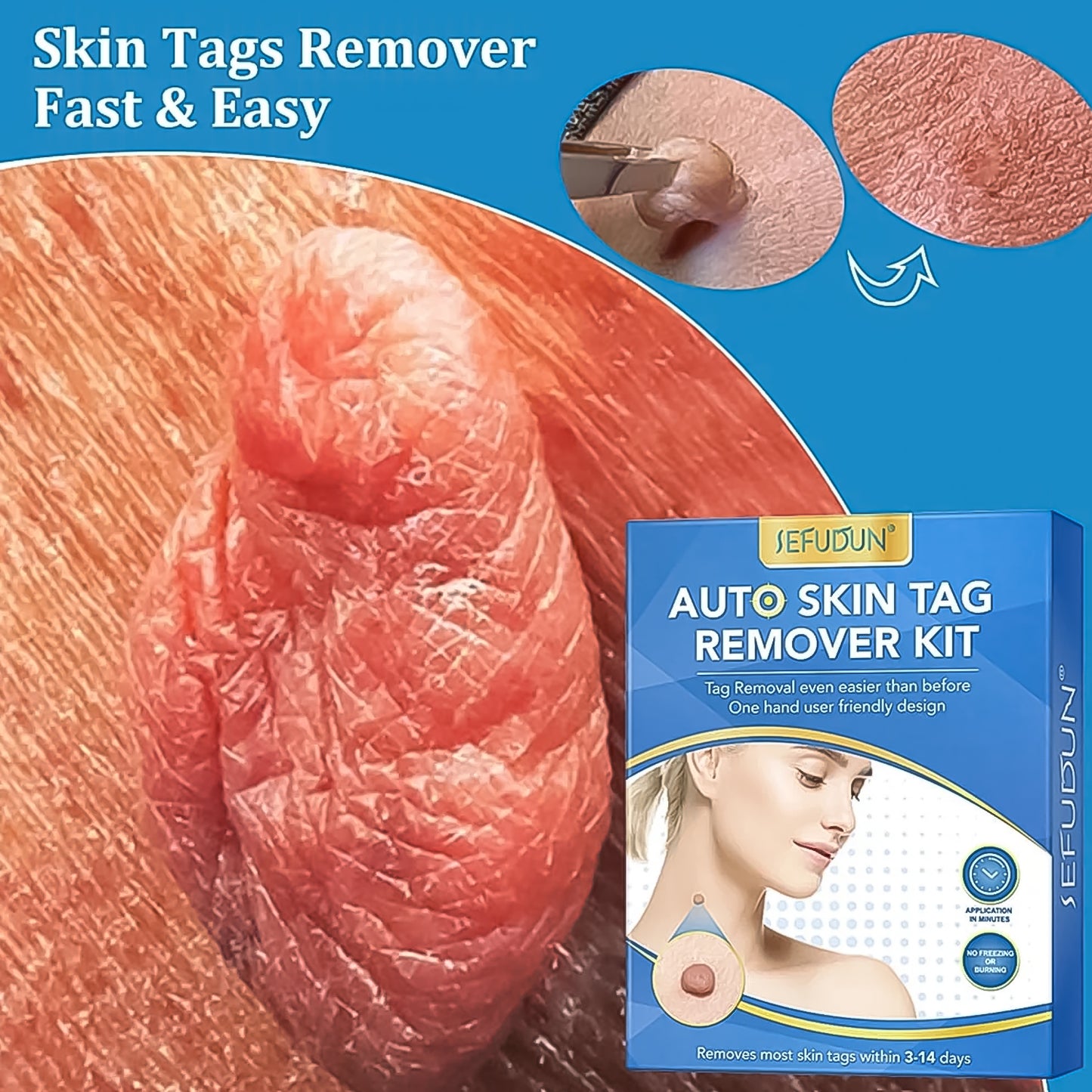 Skin Tag Remover Kit 2-in-1 (2 mm – 8 mm)